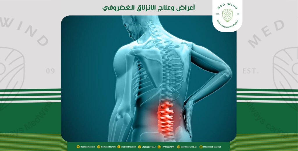 علاج الانزلاق الغضروفي
